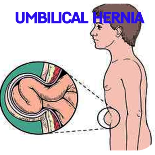 Umbilical Hernia Disease