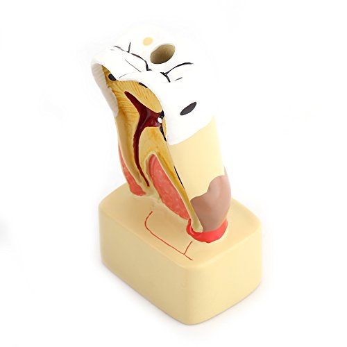 Modelo de perfil dental, modelo caries, enfermedad patológica, modelo dental completo con nervio para la enseñanza dental