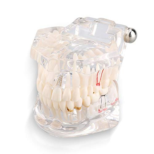 EMGAO Estudio de Enfermedad Dental Desmontable Modelo Dental de enseñanza, Modelo Dental del Programa de la Escuela Dental, Modelo de implante Dental Herramienta de demostración estándar