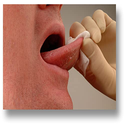 Oral Cancer - Best Treatment Options and Effective Natural Remedies