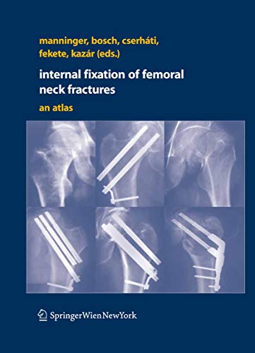 Internal fixation of femoral neck fractures: An Atlas (English Edition)