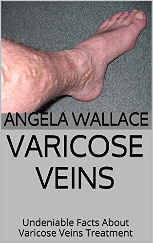 Varicose Veins: Undeniable Facts About Varicose Veins Treatment (English Edition)