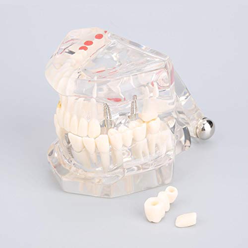 Dientes estándar Modelo-Dental Enfermedades Enseñanza Estudio Tipodonto adulto Demostración modelo de los dientes Nuevo