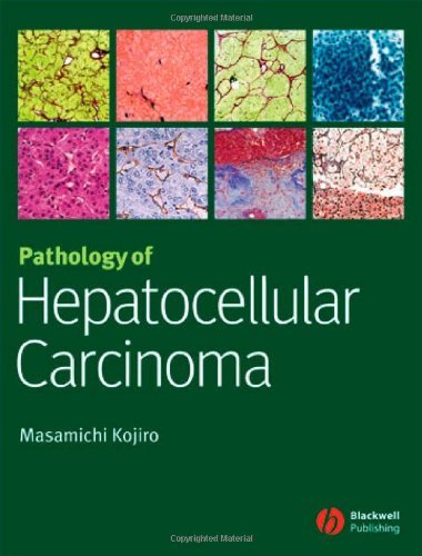 Pathology of Hepatocellular Carcinoma (English Edition)