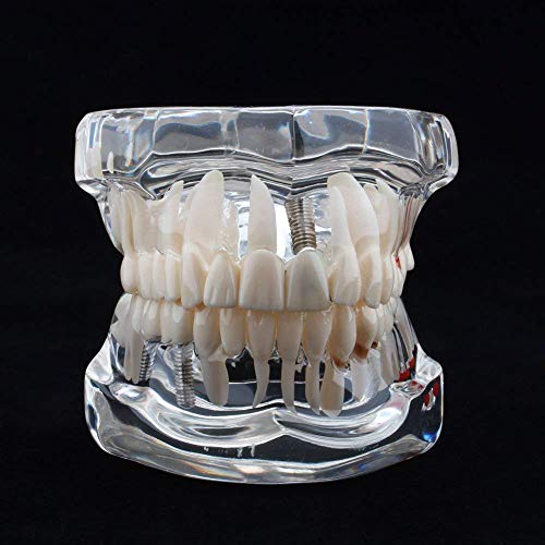 Patologías Dentales para Adultos Transparente Dentista Demostración Enfermedad Periodontal amor de Los Dientes Cuidado de los Dientes Estudio Modelo de Tipodont Estándar Extraíble