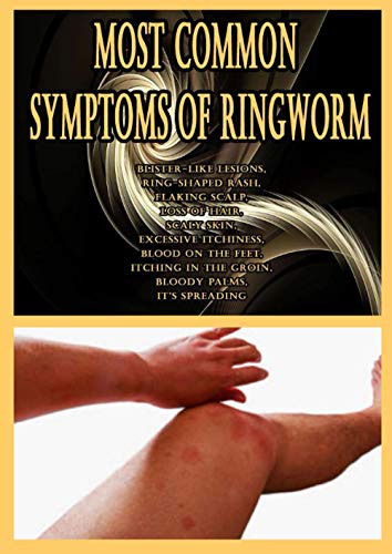 Most Common Symptoms of Ringworm: Blister-like lesions, Ring-shaped rash, Flaking scalp, Loss of hair, Scaly skin, Excessive itchiness, Blood on the ... in the groin, Bloody palms, It’s spreading