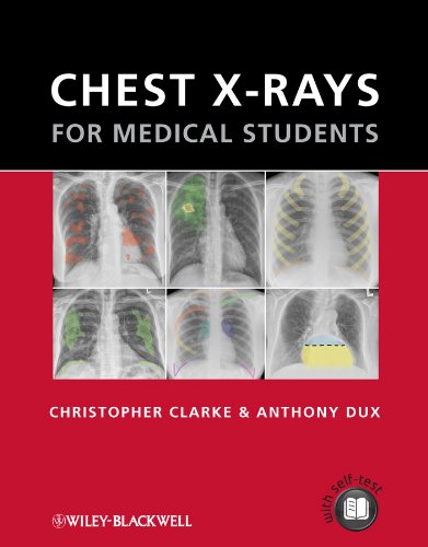 Chest X-rays for Medical Students (English Edition)