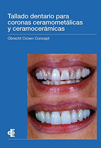 Tallado dentario para coronas ceramometálicas y ceramocerámicas: Obrecht Crown Concept